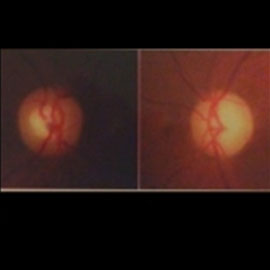 Fundus imaging